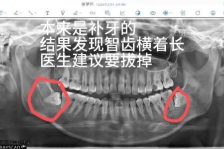 探索命理学中的智齿：揭示人生的独特意义与启示